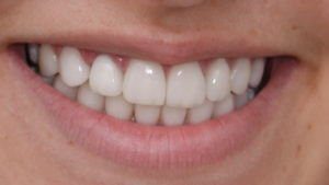 ציפוי חרסינה לשיניים תוצאה סופית