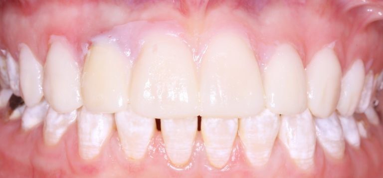 ציפויי דמה לשיניים