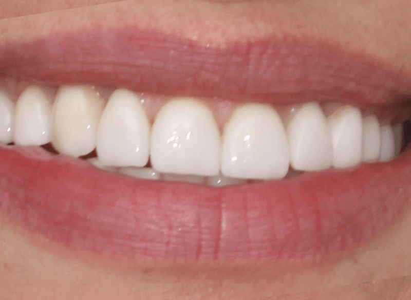 אחרי ציפוי שיניים במרפאת ד